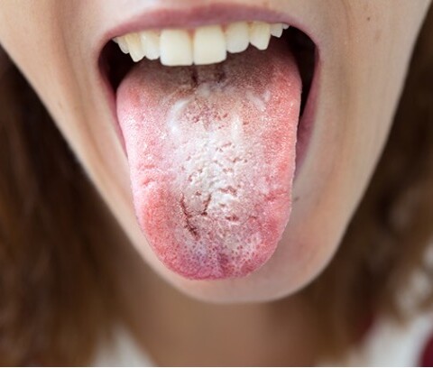 3 malattie orali contagiose