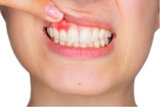 Che cos'è la parodontite o piorrea?