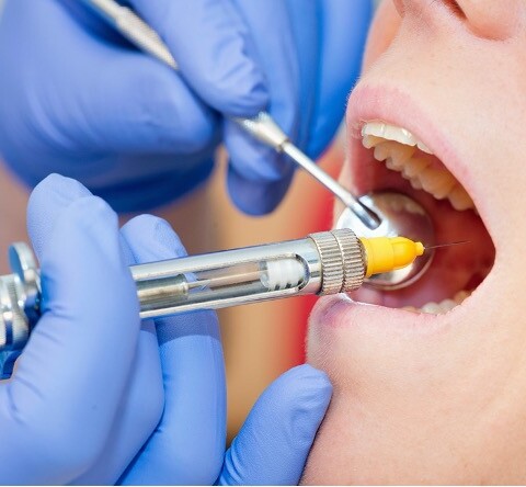 Quanto dura l'anestesia locale del dentista?