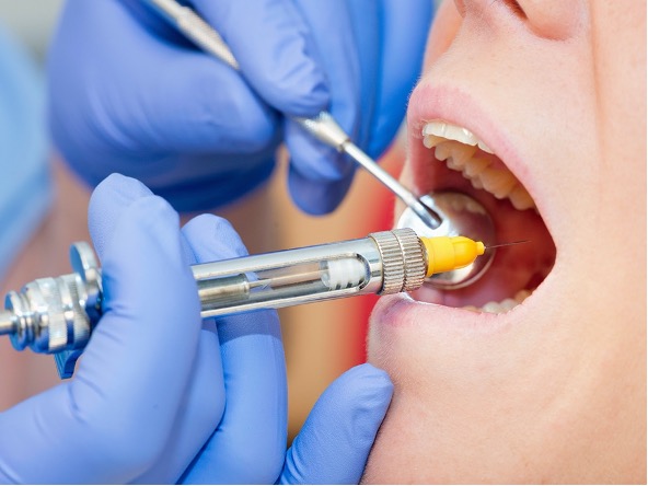Quanto dura l'anestesia locale del dentista?