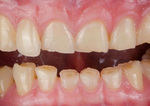 Soluzioni per l'usura dei denti e come prevenirla
