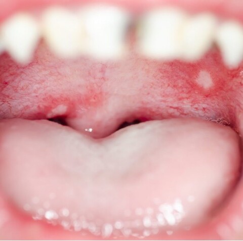 Stomatite: tipologie, cause e trattamenti